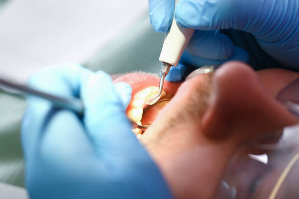 Best Knocked-Out Tooth (Avulsed Tooth) Treatment in Wildwood, FL