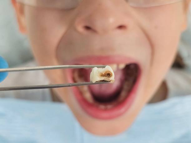 Best Emergency Wisdom Tooth Extraction in Wildwood, FL